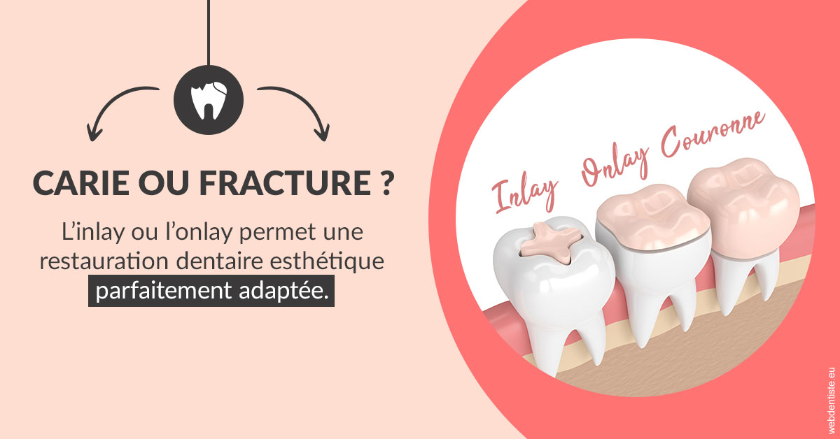 https://selas-du-dr-colas.chirurgiens-dentistes.fr/T2 2023 - Carie ou fracture 2