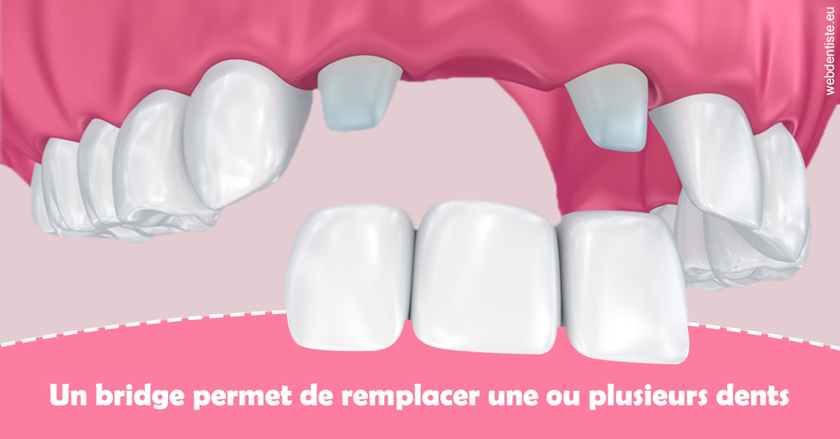 https://selas-du-dr-colas.chirurgiens-dentistes.fr/Bridge remplacer dents 2