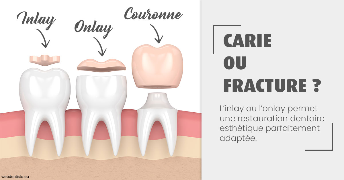 https://selas-du-dr-colas.chirurgiens-dentistes.fr/T2 2023 - Carie ou fracture 1