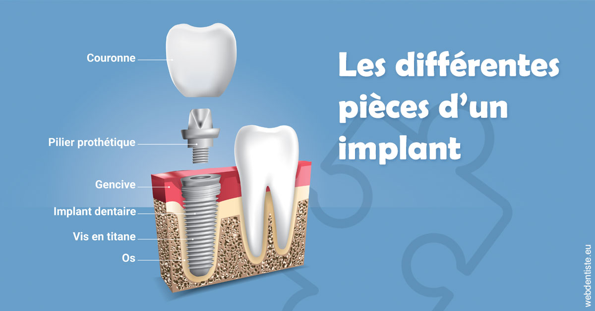 https://selas-du-dr-colas.chirurgiens-dentistes.fr/Les différentes pièces d’un implant 1